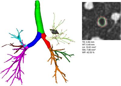 MDCT-based longitudinal automated airway and air trapping analysis in school-age children with mild cystic fibrosis lung disease